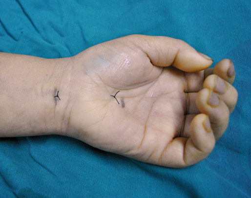 1547804612264039988.png 16.我院成功开展微创关节镜治疗腕管综合征手术3.png